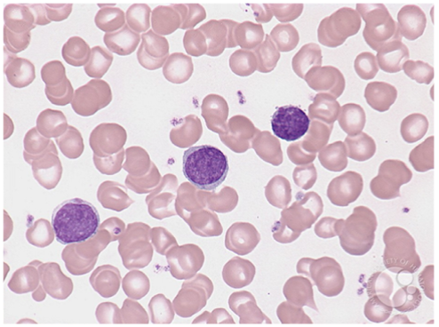 Lymphomes non Hodgkiniens | Ellye